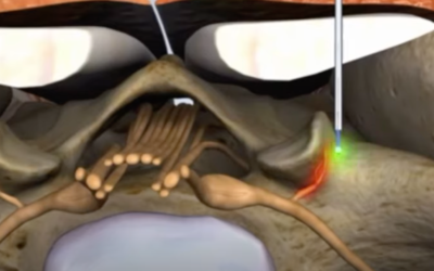 The Benefits of Laser Facet Nerve Ablation: A Modern Solution for Back Pain